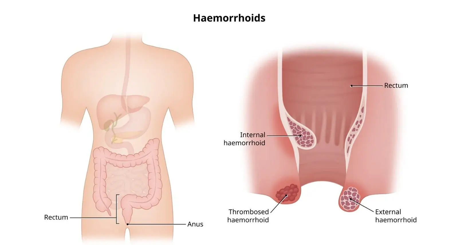 What Are Piles (Hemorrhoids)?